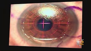 ZLASIK  Bladeless Laser Vision Correction [upl. by Nylecsoj]