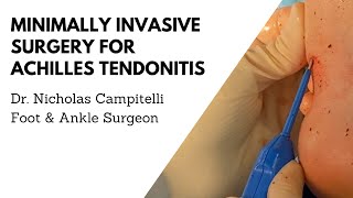 Achilles Tendonitis Treatment with Surgical Debridement Using TenJet Dr Nicholas A Campitelli [upl. by Sperry]