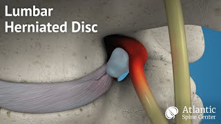 Lumbar Herniated Disc Overview [upl. by Anilrats605]