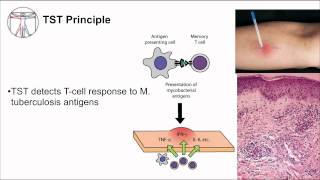 Tuberculosis Diagnosis [upl. by Ajad]