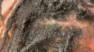 How to remove scalesdandruff or seborrheic dermatitis from the scalp [upl. by Aeduj]