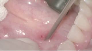 Submandibular Salivary Gland Sialendoscopy for Sialolithiasis [upl. by Akerue]