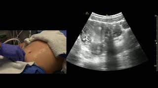 How To Ultrasound FAST Exam  Male Pelvis [upl. by Xirdnek]