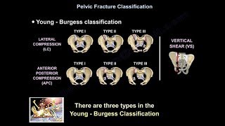 Pelvic Fractures  Everything You Need To Know  Dr Nabil Ebraheim [upl. by Latrina]