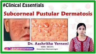 Subcorneal Pustular Dermatosis  Clinical Essentials   Dr Aashritha yerneni [upl. by Chui752]