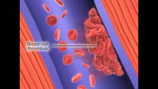 Atherectomy for Peripheral Arterial Occlusive Disease  Part 2 [upl. by Jeremiah794]