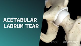 Acetabular Labrum Tear  Pathologies [upl. by Mroz925]