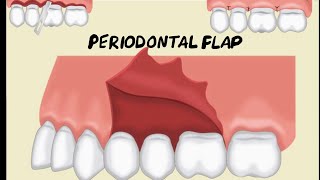 Periodontal Flap [upl. by Namie]