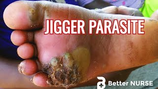 Jiggers Impact on Humans and Animals [upl. by Ennael]