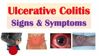 Ulcerative Colitis Signs and Symptoms amp Why They Occur and Complications [upl. by Willing]