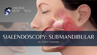 Sialendoscopy for Submandibular Gland Stones [upl. by Toback752]