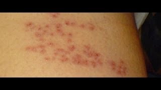 How Can You Prevent Shingles [upl. by Jannelle]