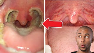 Tonsil Stone  Tonsillectomy [upl. by Maleen178]