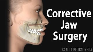 Corrective Jaw Orthognathic Surgery Animation [upl. by Yrrat784]