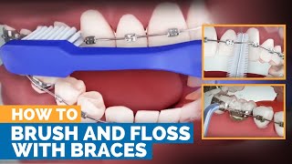 How to Brush amp Floss with Braces [upl. by Ahkihs]