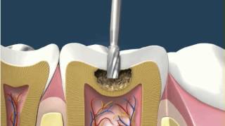 Dental Fillings White Amalgam 1 [upl. by Ahseena]