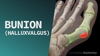 Bunion Hallux Valgus [upl. by Lucio]