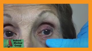 A Stye and a Chalazion  Auburn Medical Group [upl. by Tab]