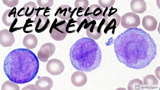 Acute Myeloid Leukemia AML w Monocytic Differentiation formerly AMML with Blasts amp Promonocytes [upl. by Mandeville]