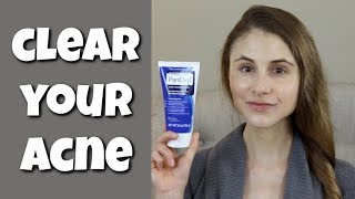 HOW TO CLEAR YOUR SKIN WITH BENZOYL PEROXIDE DR DRAY [upl. by Chretien759]