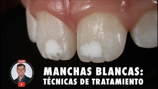 Manchas blancas Técnicas de tratamiento [upl. by Jefferson]