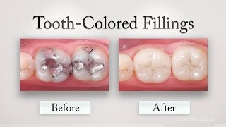 Tooth Colored Fillings [upl. by Inej]