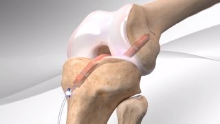 BioCartilage® Allograft Cartilage Repair in the Ankle [upl. by Gehman]