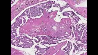 Breast Cancer Pathology Reports What You Need to Know [upl. by Nail]