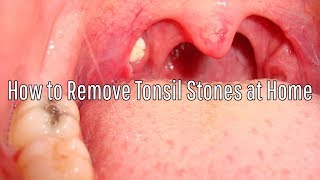 How to Remove Tonsil Stones at Home [upl. by Schwing881]