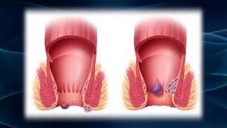 Hurting From Hemorrhoids [upl. by Gurtner]