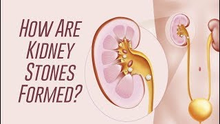 Removal of kidney stones URS [upl. by Nomelc734]