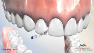 Interproximal Reduction or IPR  Polishing Strip [upl. by Ligetti]