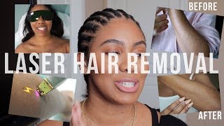 Laser Hair Removal Things To Know  Before amp After  zoerudd [upl. by Aikehs]