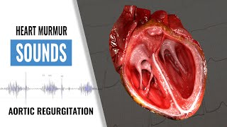 Hypokinesis Mitral Regurgitation Aortic Insufficiency [upl. by Aggappe506]