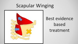 Scapular Winging Causes and Treatment [upl. by Sineray]