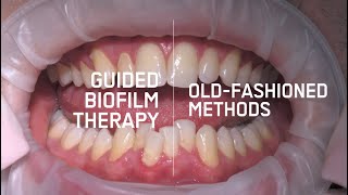 Guided Biofilm Therapy VS Old Hygiene Treatment [upl. by Reggy]