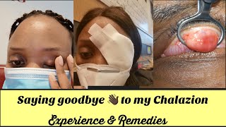 CHALAZION REMOVAL  EYE SURGERY MY EXPERIENCE amp REMEDIES [upl. by Marcelia]