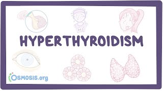 Hyperthyroidism Signs and Symptoms Mnemonic  SWEATING [upl. by Atsirt]