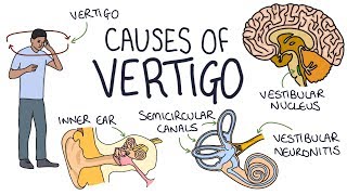 Vertigo Treatment  Epley Maneuver  American Academy of Neurology [upl. by Mccartan]