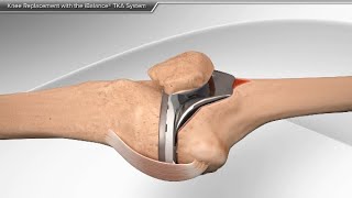 Knee Replacement with the iBalance TKA System [upl. by Magdau]