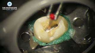 How to place calcium hydroxide [upl. by Azelea]