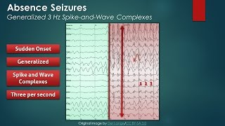 Understanding Infantile Spasms [upl. by Lazos]