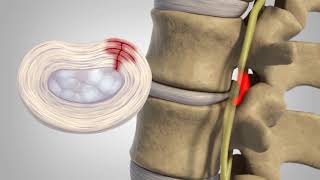 Herniated Disc  Patient Education [upl. by Strickler]