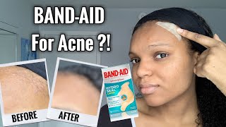 BANDAID FOR ACNE  I Tested Hydrocolloid Bandages for 1 Week  Hydro Seal BandAid for Acne [upl. by Elizabet]