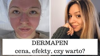 DERMAPEN  MEZOTERAPIA MIKROIGŁOWA  GENEO [upl. by Marlene]