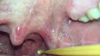 Tonsil Stone Extraction [upl. by Avron476]