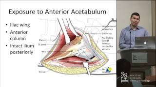 Acetabulum Approaches  Conor Kleweno MD [upl. by Mickelson]