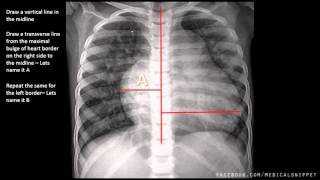 Cardiomyopathies Dilated Restrictive Hypertrophic Cardiac Pathology [upl. by Crispa]