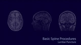 FluoroscopyGuided CSF Drain Spinal Drain  Demo and Anatomy Review [upl. by Arinaid]