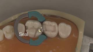 Class II Composite Restoration  Stevenson Dental Solutions [upl. by Adniled]